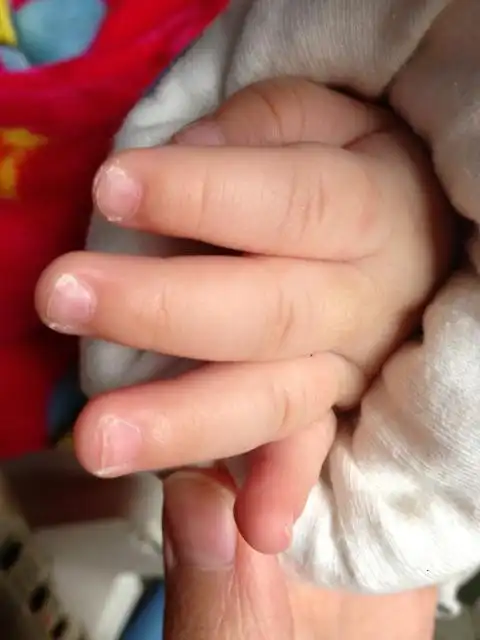 宝宝指甲这样是缺钙吗?