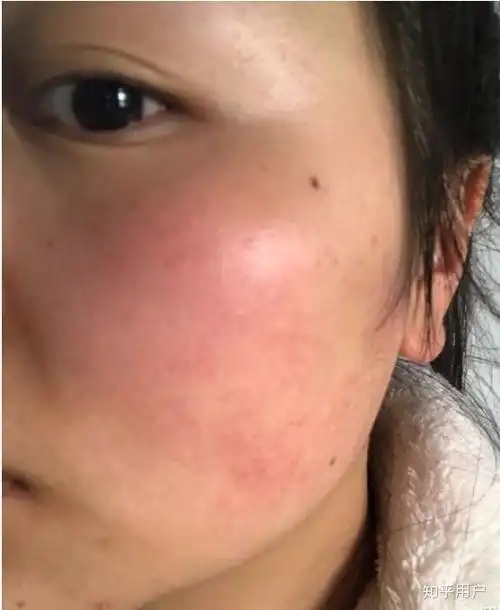 角质层薄应如何修复