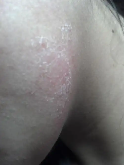 腿部夏季皮炎症状图片大全_有来医生