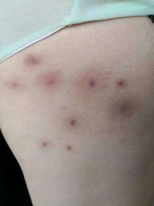 颈部腋下臀部腹股沟多发毛囊炎疤痕结节症状.印象毛囊闭锁三联.