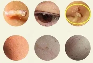 图片真实女性早期hpv感染图片(低危型各种寻常疣)(4)黏膜高危型hpv-16