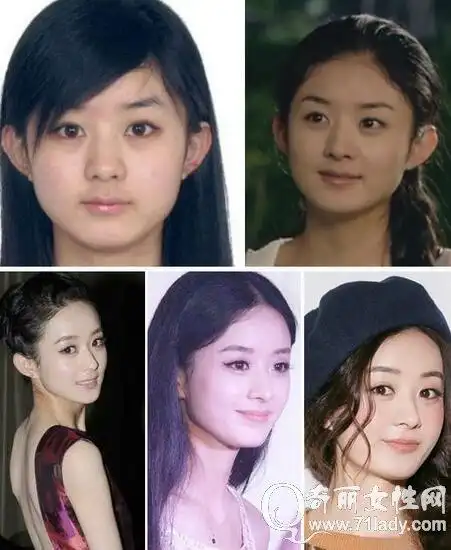 赵丽颖整容前后照片 整容前脸又方又圆整容后秒变小圆脸女神