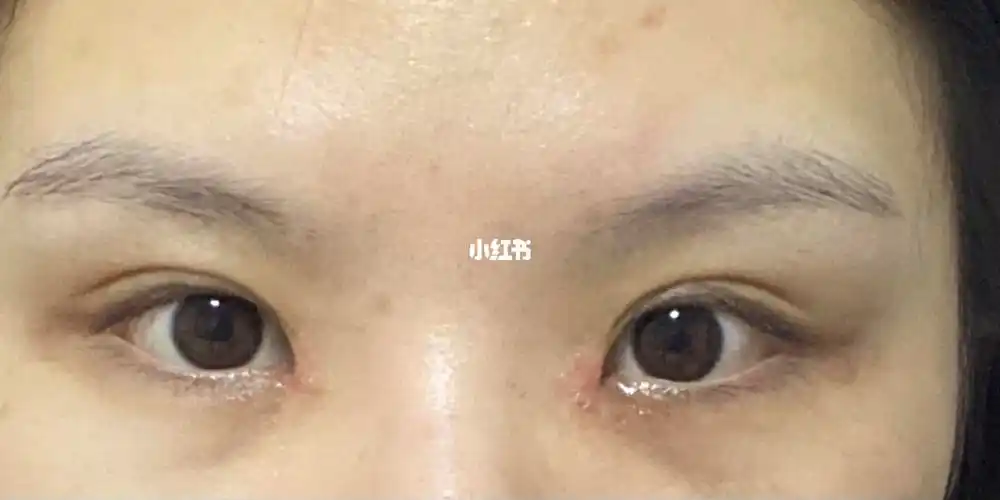 内眼角回包39天