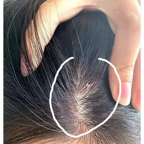 长头皮屑洗什么洗发水好?祛痘止痒洗发水推荐_去屑_问题_效果