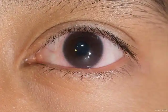 近视了却不戴眼镜时间久了会怎样眼睛会变成什么样子