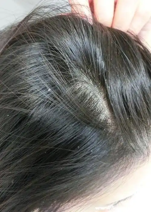 头皮痒头皮屑多头上有头皮屑特别多还很痒怎么办