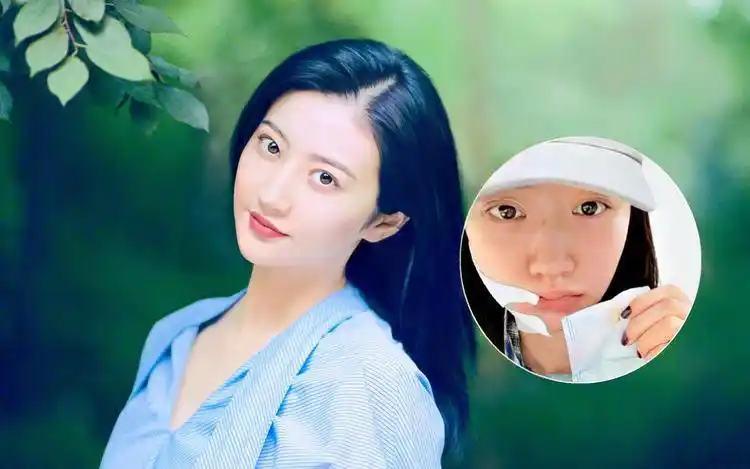 景甜拔智齿后首露面,右脸肿成包子气色憔悴,脱妆后鼻梁疤痕明显