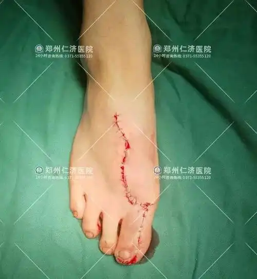 切取后的脚部外观