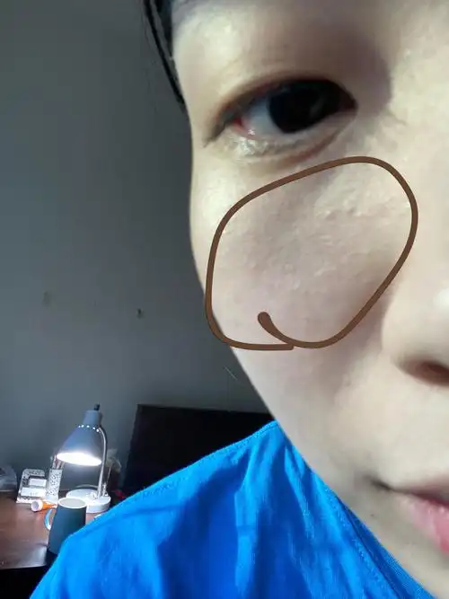皮肤上有这种小颗粒是什么引起的呀图很大小心