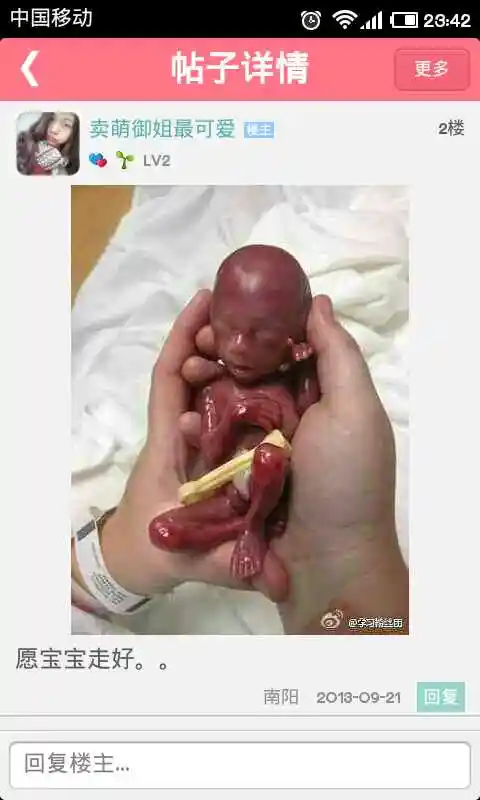 [2014年2月妈妈帮]网上看到的19周早产儿,太心疼了