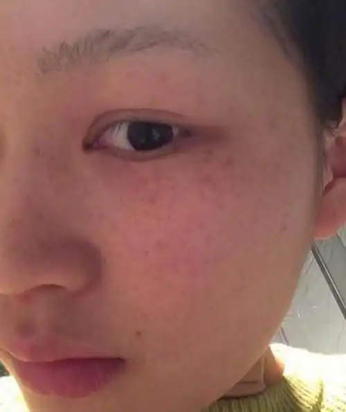 黑人女性面部长色斑图片