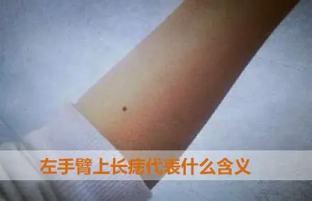 左手臂上长痣代表什么含义