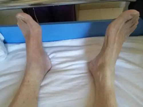 做理疗,糖尿病患者腿成"大象腿"究原因——竟是血栓阻塞