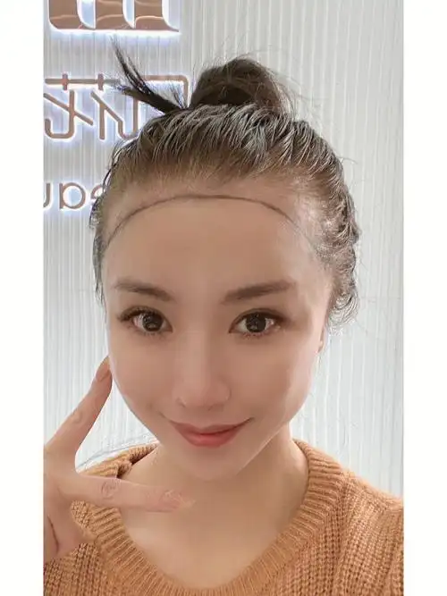 发际线太高怎么办757575