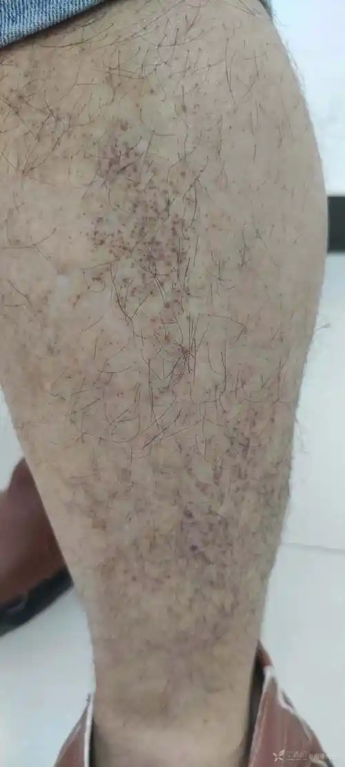 淀粉样变请教各位老师