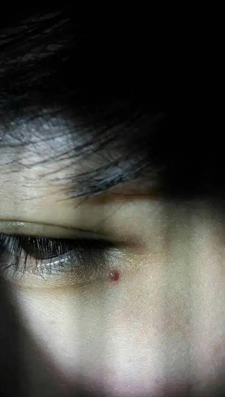 眼角上长了个红色的小疙瘩?不知道是啥.怎么弄好啊
