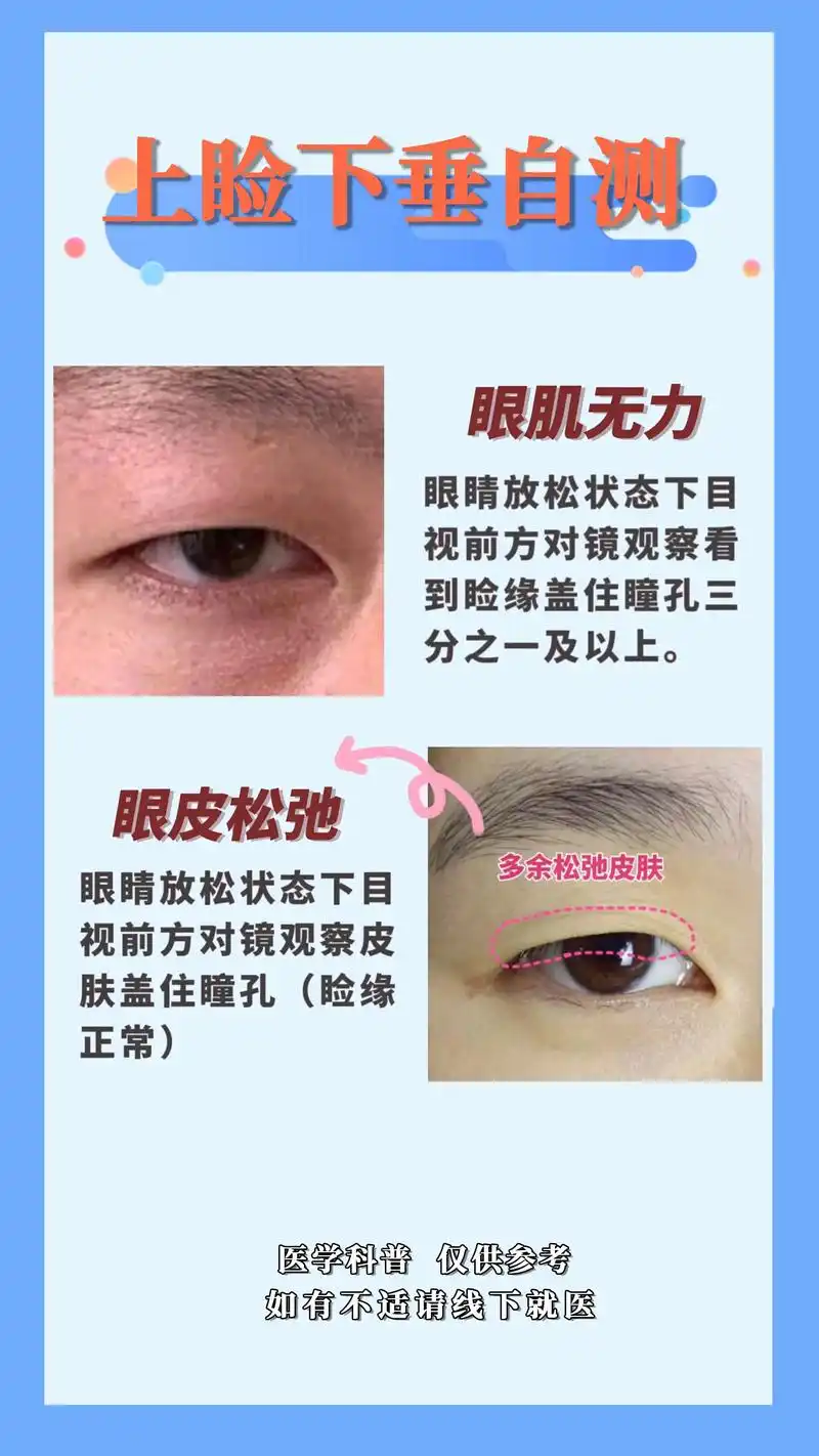 上眼皮肌无力怎么治 - 抖音