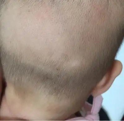 六个多月的女宝后脑勺这几天露出一小块白色的头皮,之前长得有头发
