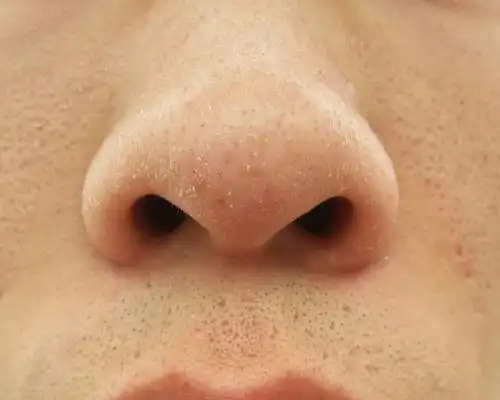 脸上和鼻头上经常有这种白色的东西,也不好清除,是不是角质还是死皮