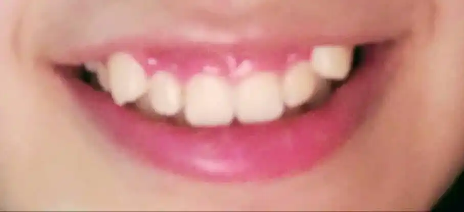 有两颗虎牙,右边虎牙几乎完全错位,而且笑的时候会露牙龈,要不要戴