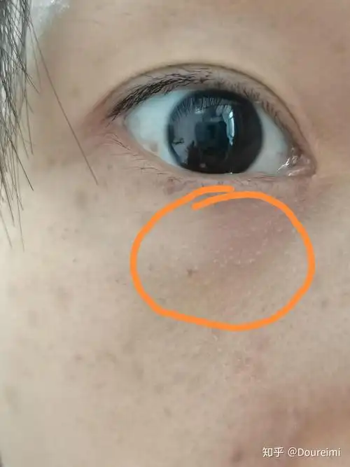 谁知道眼睛下面长这个是什么呀