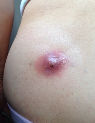 臀部火疖子图片4