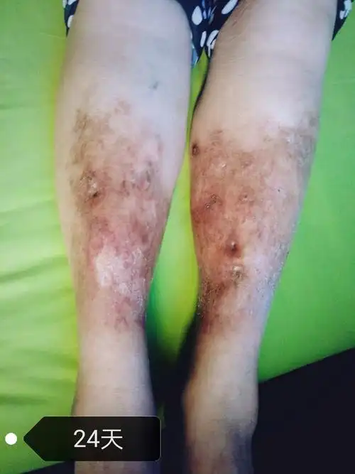 术后24天,皮肤状态不断改善,原来流液的皮肤破溃已经愈合.