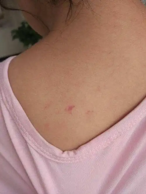 前段时间,静静的宝宝头上长出了几颗红疙瘩,她以为被什么小虫子咬了