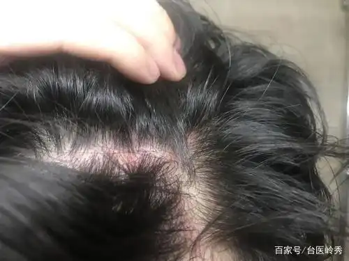 为何头皮总长疙瘩和脓包或和3种疾病有关及早了解