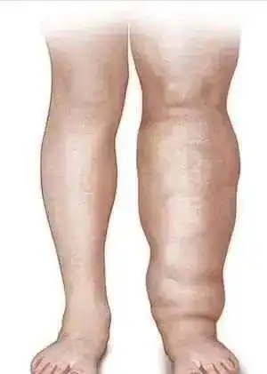 潍坊市人民医院专家为您讲解:"象皮腿"只是肿了而已吗?