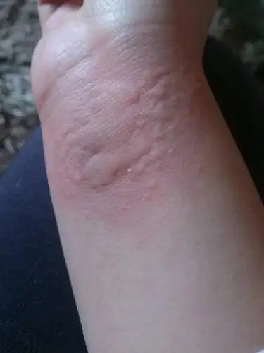 自己百度对照这个好像是寒冷性荨麻疹,身上有好多,这是手腕上的,开始