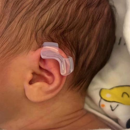 耳朵矫正器医用  婴儿耳朵矫正器宝宝耳廓纠正器新生儿耳畸形招风耳垂