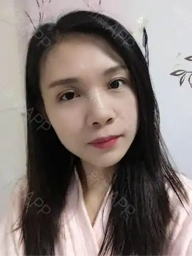 埋线双眼皮项目术后第10天