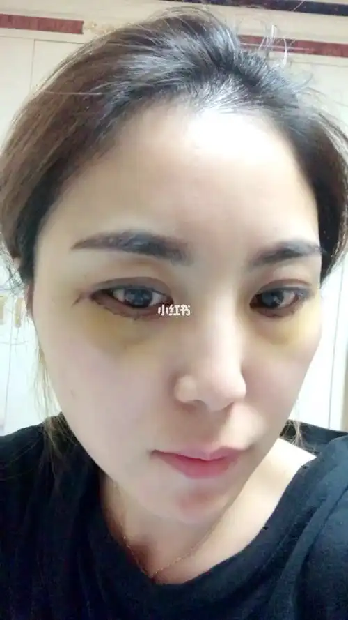 外切眼袋框隔释放泪沟填充第三天