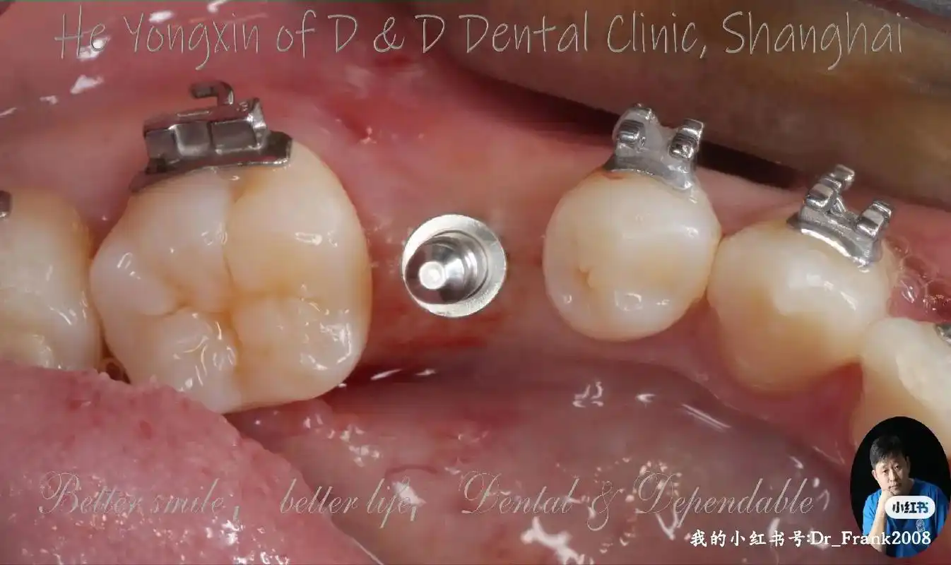 总结一例诺保科种植牙加on1基台案例.早安,朋友们.今天地铁 - 抖音