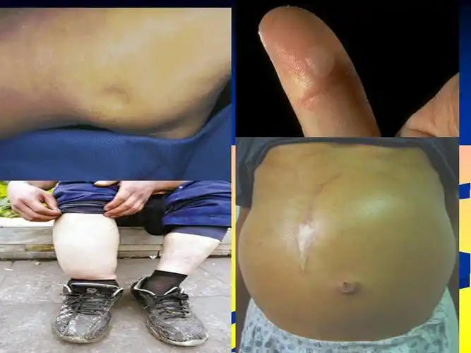 水肿临床本科ppt课件ppt