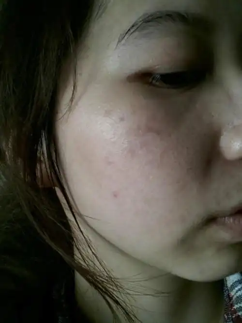 月子宝宝脸上湿疹图片