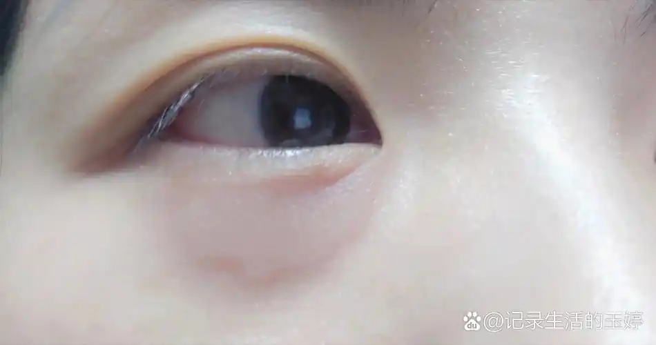 眼睛下面有时候会莫名肿一个包!