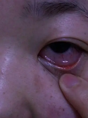 下眼皮突然肿了,然后一挤出来透明白色的东西.挤不出来感觉长在里面.