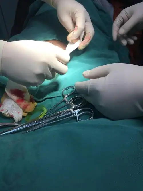 吻合器包皮环切术美观,操作方便,值得推荐,但其费用稍高,且需要取钉子