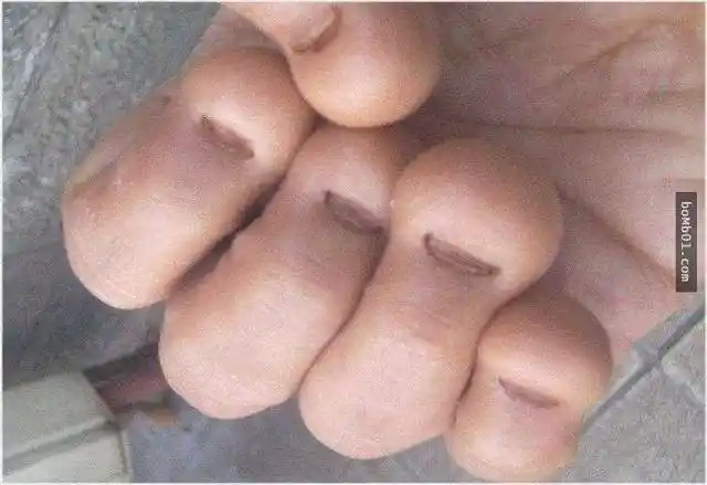 咬指甲(nailbitting)是指儿童反复出现的自主或不自主的啃咬手指甲的