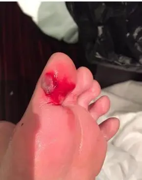 陈乔恩晒淤血照粉丝直呼心疼