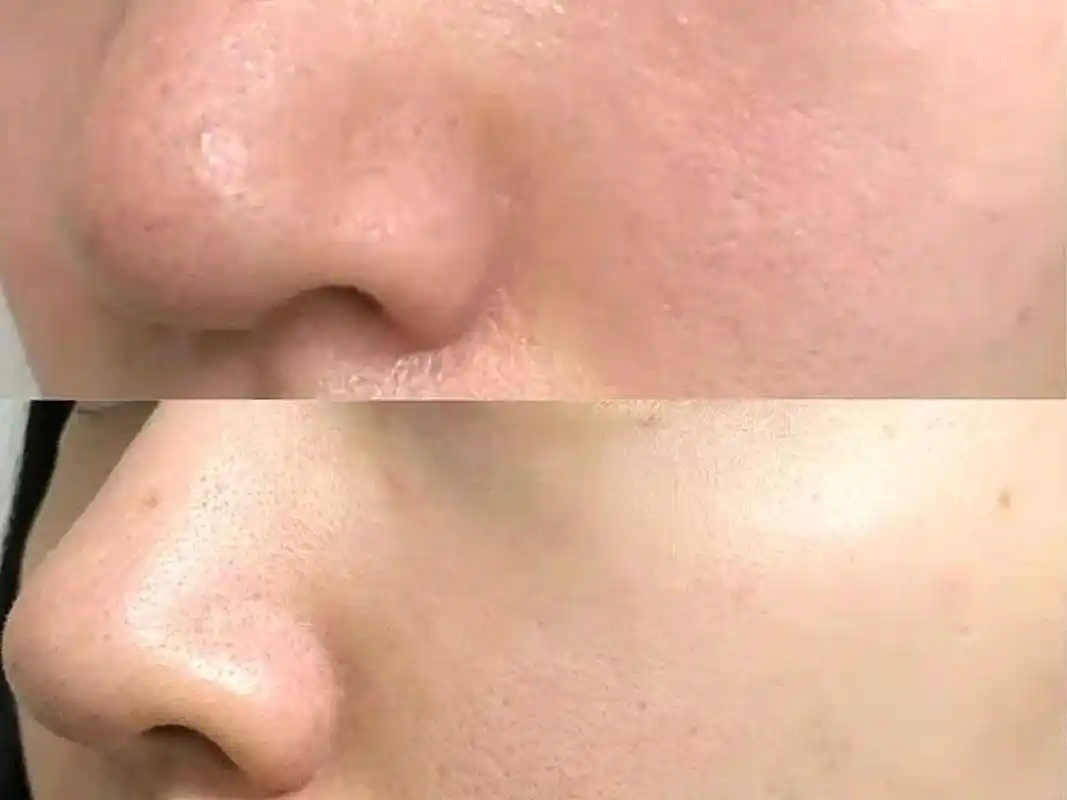 答:不一定 第一:医美收缩毛孔能够持续多久时间呢?