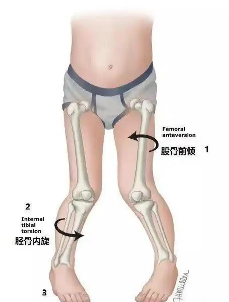 小孩内八字走路,有时甚至可以自己绊倒自己,家长纠结,究竟要不要纠正?
