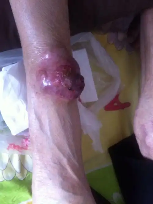 年近九十高龄,腿部长个不知啥瘤,到医院检查也未确定,现已破皮,还有时