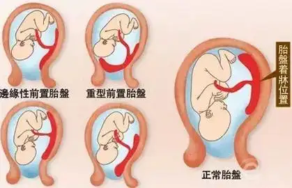 胎盘低是怎么回事胎盘低怎么办