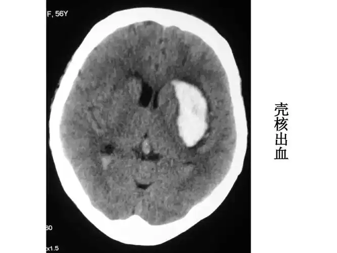 影像总结头颅ct基本知识与常见病变