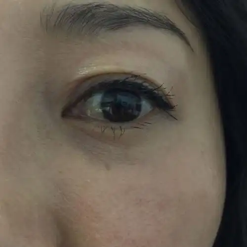 眼睛内侧眼白的部分,应该叫晶状体吗,凸起,因此眨眼和