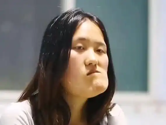 "歪脸女孩"变美后走红,拒绝签约当网红,她的选择令人敬佩