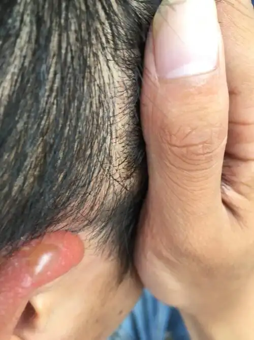 耳朵上长了水泡怎么办